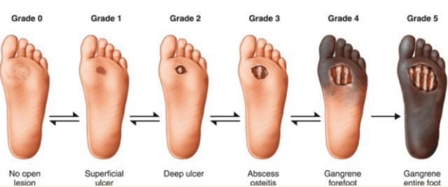 Ciri-ciri Luka Diabetes Basah di Kaki dan Cara Penanganannya