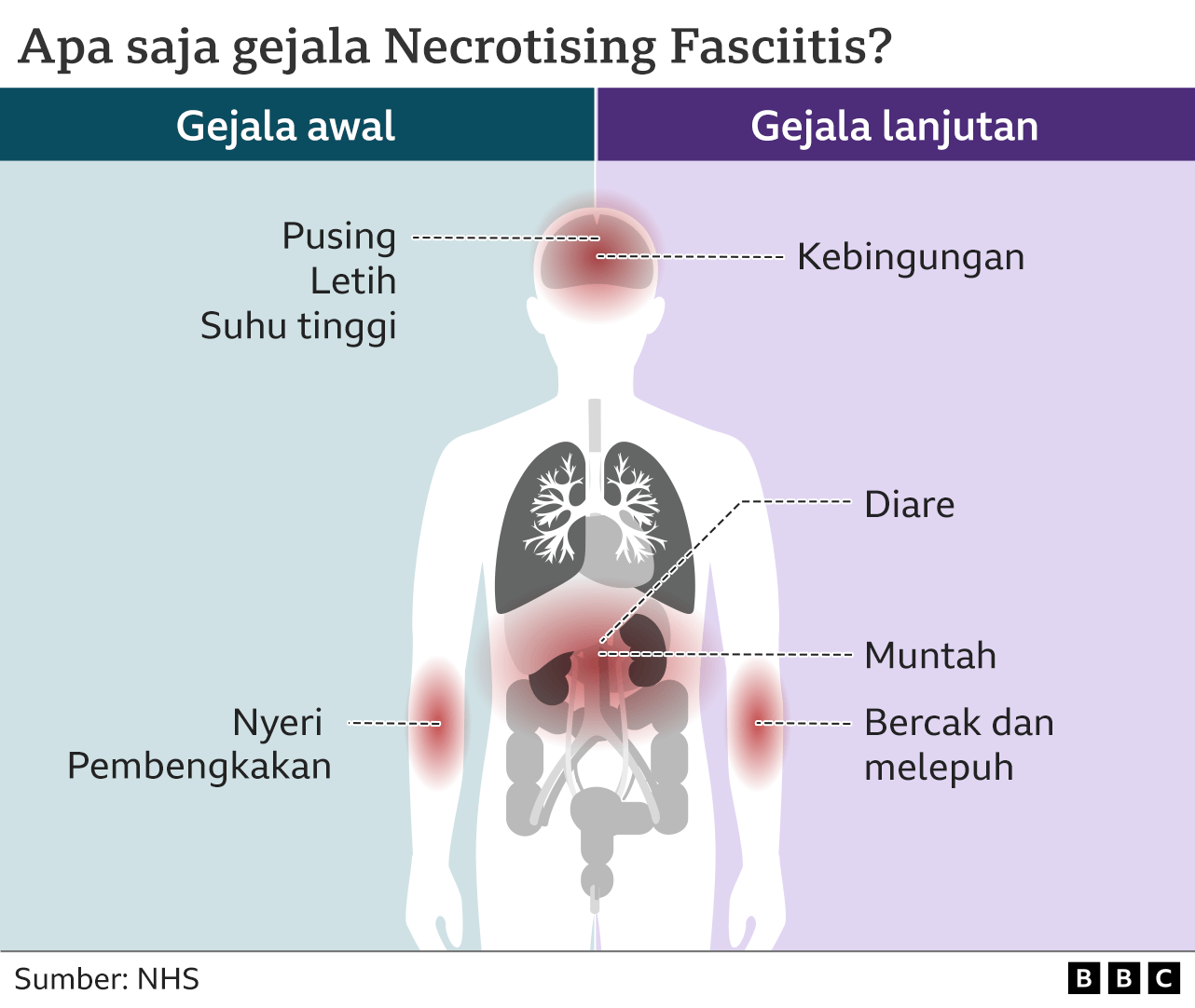 Kasus Infeksi Bakteri Pemakan Daging Meningkat, Ilmuwan Ungkap Dugaan Pemicunya