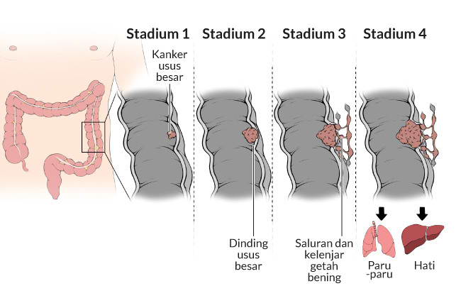 Kebiasaan Konsumsi Makan Ini Jadi Pemicu Banyak Warga Korsel Kena Kanker Usus Besar