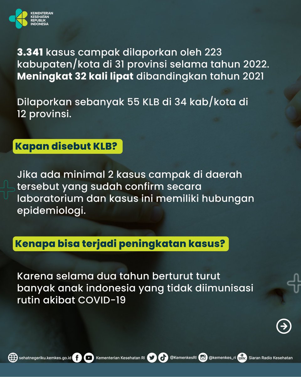 Menkes: Penyakit Campak Lebih Menular Dibandingkan Covid-19 : Okezone Women