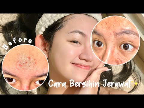 Viral Minum Matcha Bikin Wajah Bebas Jerawat, Dermatolog Bilang Gini