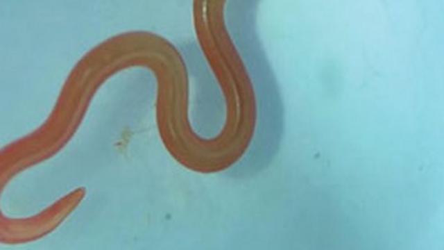 Ada Cacing Hidup 18 Cm di Otak Pasien, Ternyata Masuk ke Tubuh Lewat Ini