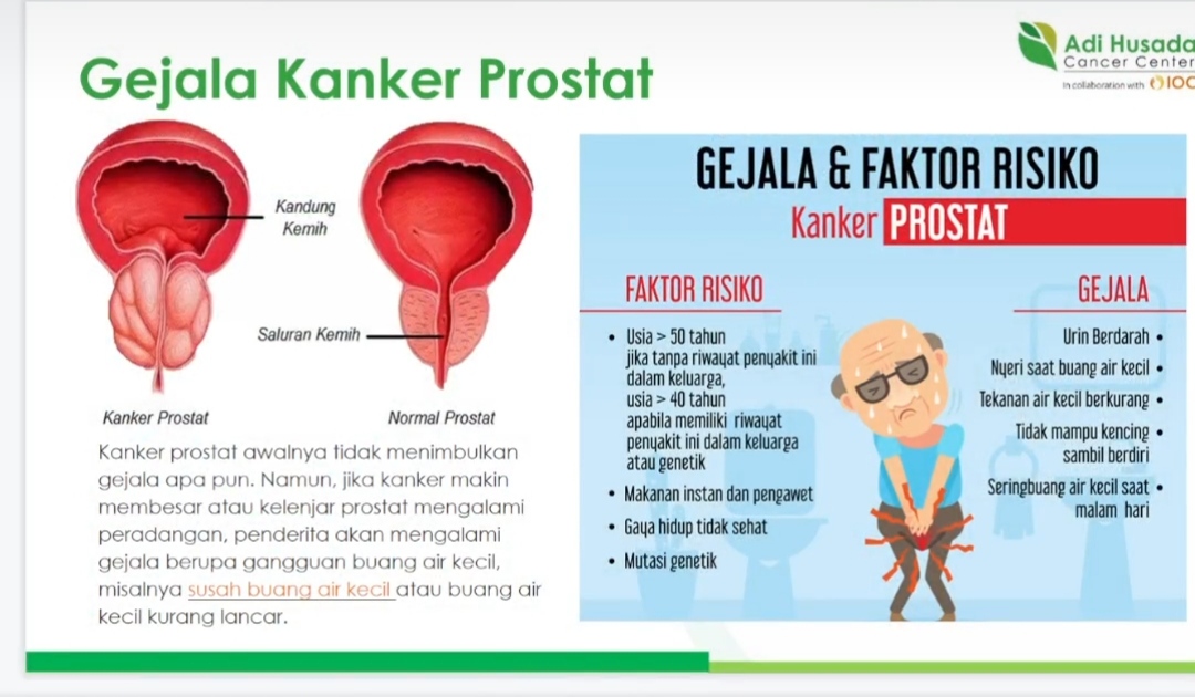 Kanker Prostat 'Hantui' Pria AS, Kebanyakan Kasus Telat Terdeteksi