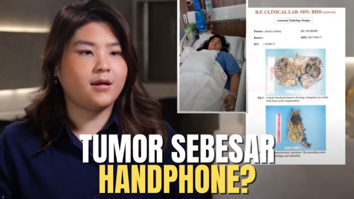 Kisah Wanita Idap Tumor Otak di Usia 20-an, Ukurannya Sudah Sebesar Alpukat