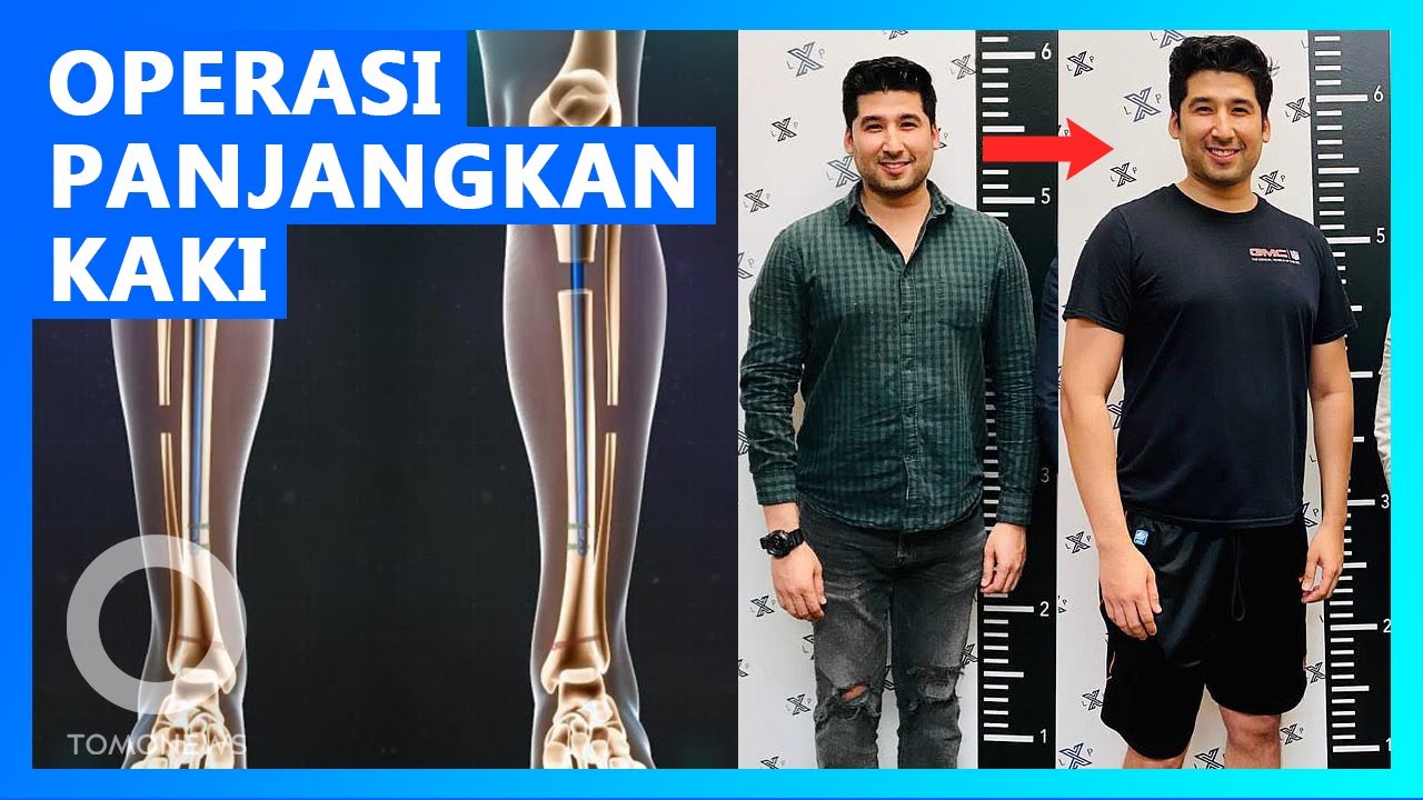 Nggak Pede Tinggi 'Cuma' 175 Cm, Pria Ini Jalani Operasi Peninggi Badan