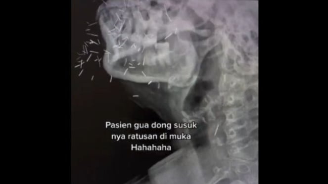Penampakan Ratusan Benang 'Susuk' Emas di Tubuh Pasien, Masuk Lewat Mana?