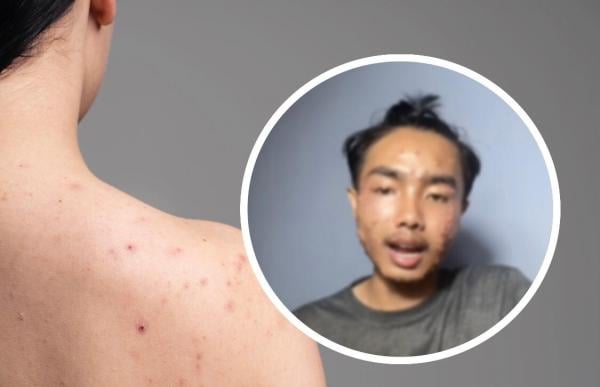 Pria Ini Kena Penyakit Langka, Tangan dan Kakinya Bak Kulit Kayu