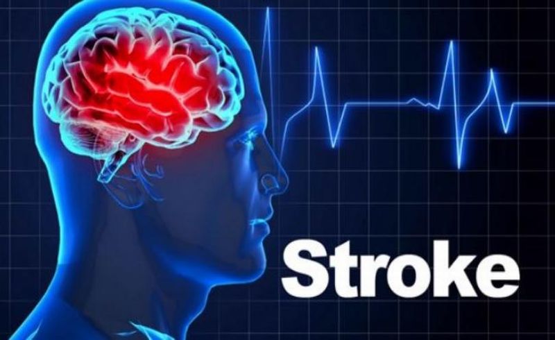 Stroke Bisa Dicegah Pakai Cara Ini, Simak Penjelasan Dokter.